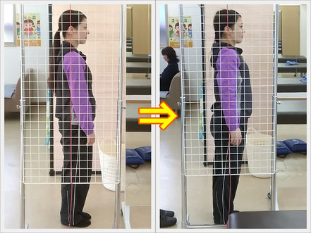 きついガードルは女性の敵！？